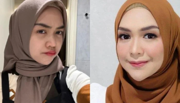Benarkah Operasi Hidung Ria Ricis Menghabiskan Ratusan Juta Rupiah? Simak Penjelasannya!
