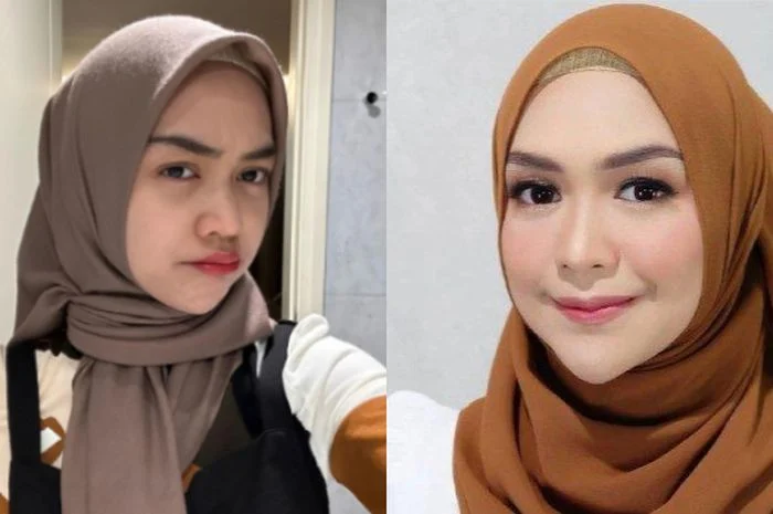 Benarkah Operasi Hidung Ria Ricis Menghabiskan Ratusan Juta Rupiah? Simak Penjelasannya!